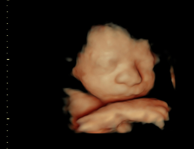 3D ultrasound image at 31 weeks